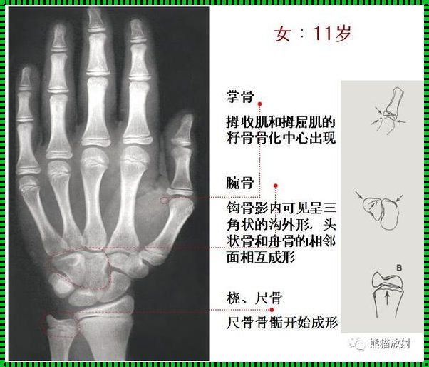 儿童测骨龄揭秘：探寻生长的秘密