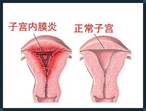 慢性子宫内膜炎治疗时长探讨