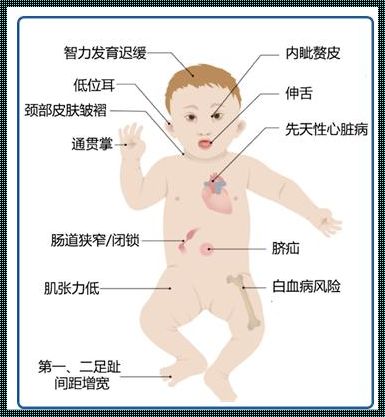 孕妇怀唐氏儿典型症状：深入了解与关爱